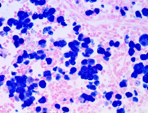 IHC of ALK on a FFPE Anaplastic Large Cell Lymphoma Tissue